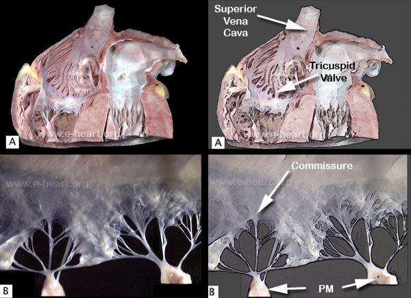 Tricuspid Valve